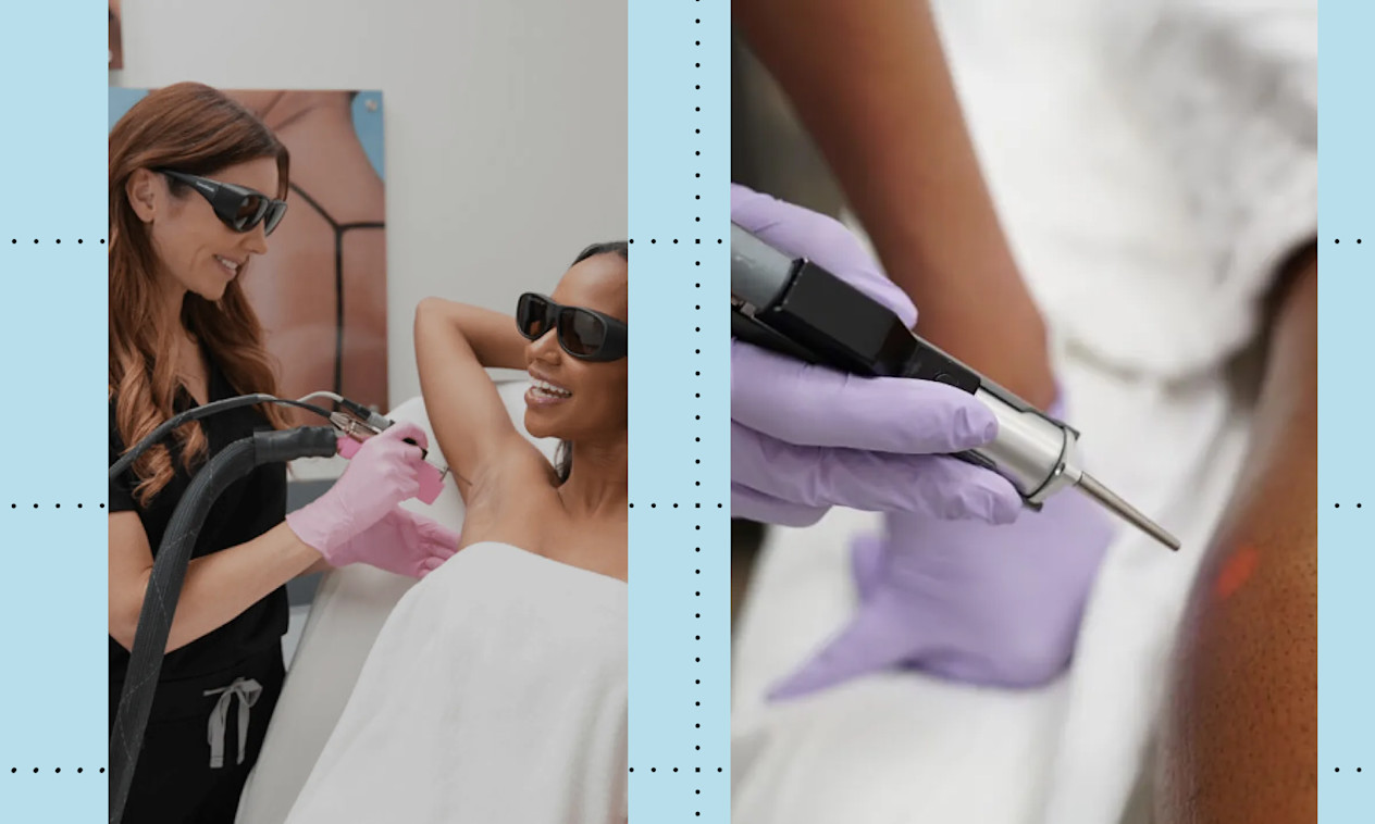 laseraway laser hair removal review